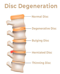 disc degenration